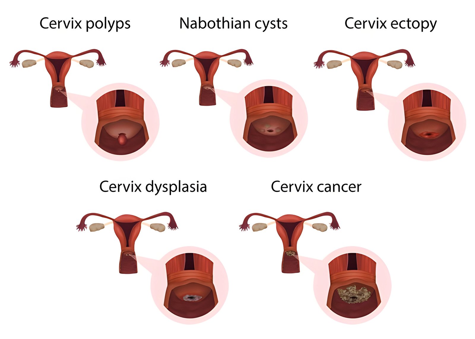 Nabothian Cyst: Common Causes and Available Treatments