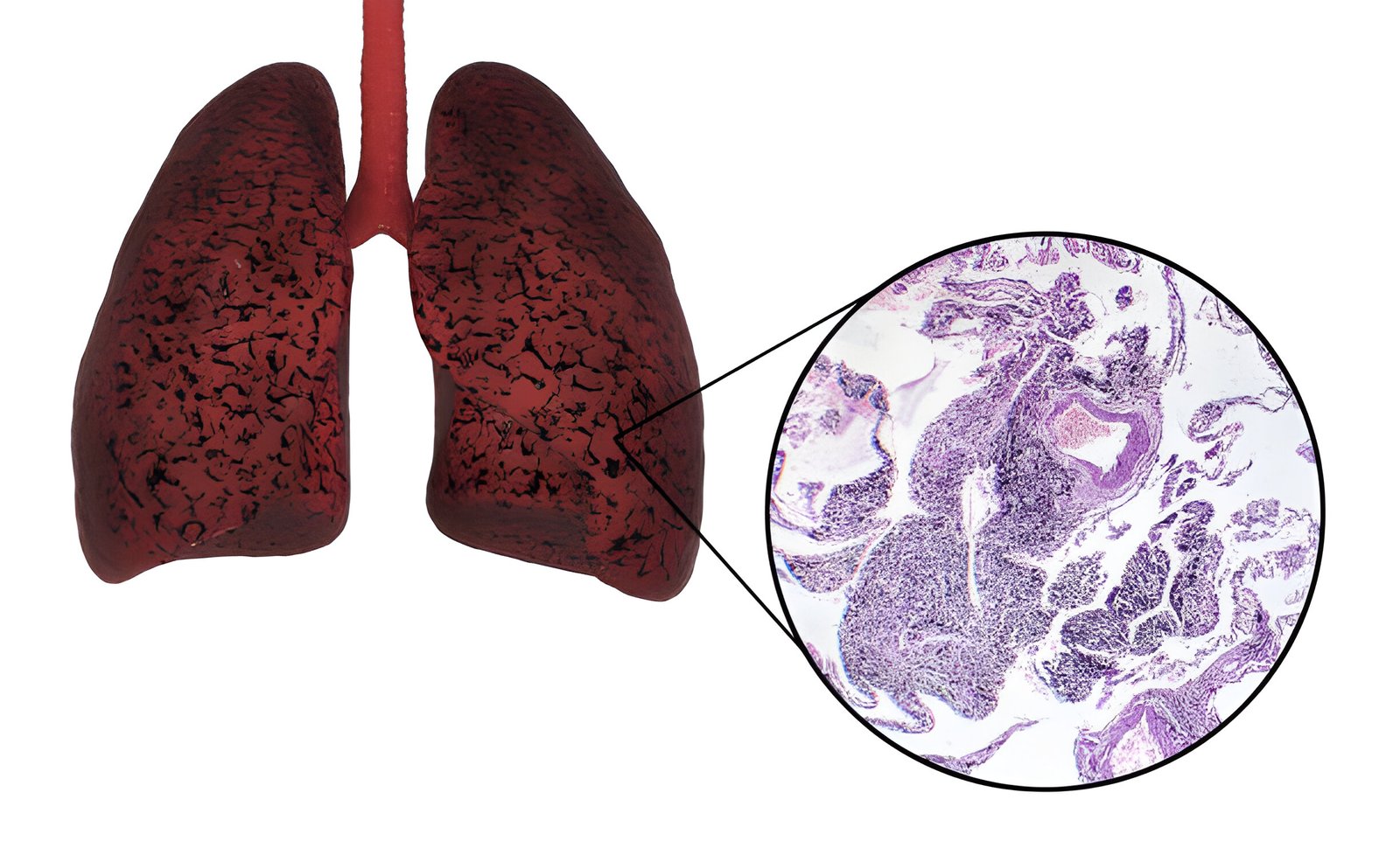 Bibasilar Atelectasis Explained: Diagnosis and Therapy Options