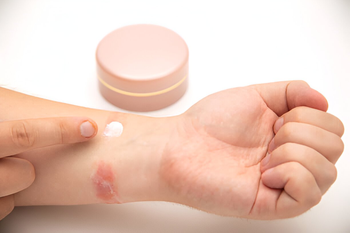 Bacitracin Ointment Explained: Uses, Benefits, and Risks