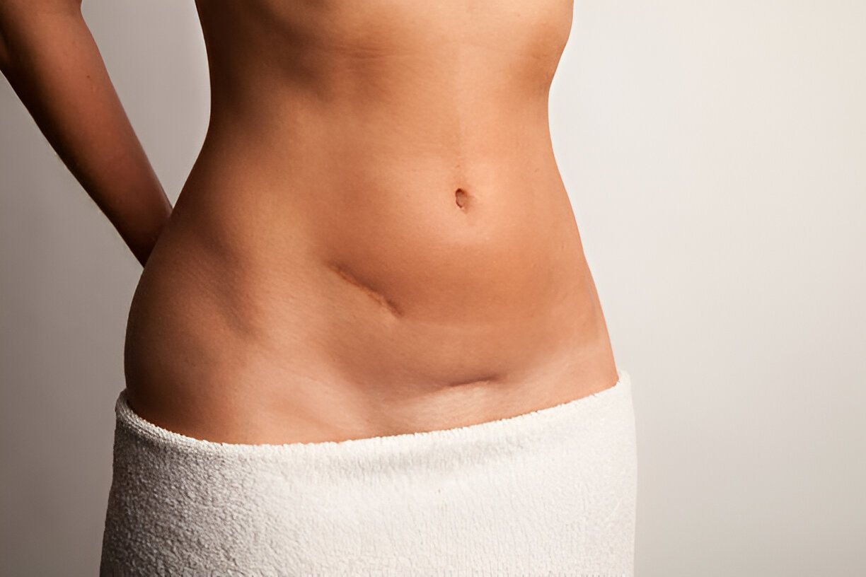 How Your Stomach Transforms Before and After Hernia Surgery