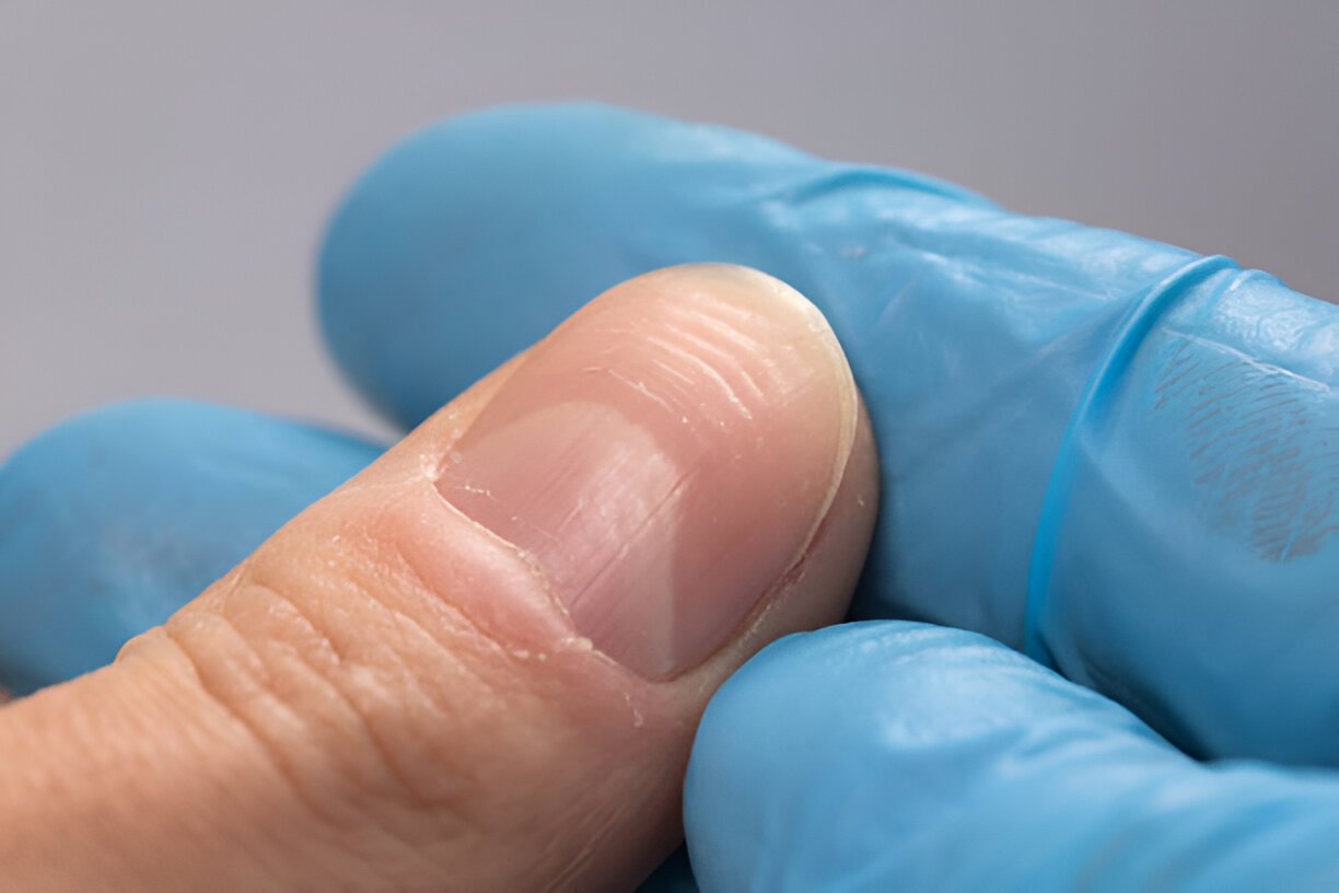 How Vitamin Deficiency Leads to Vertical Ridges on Nails