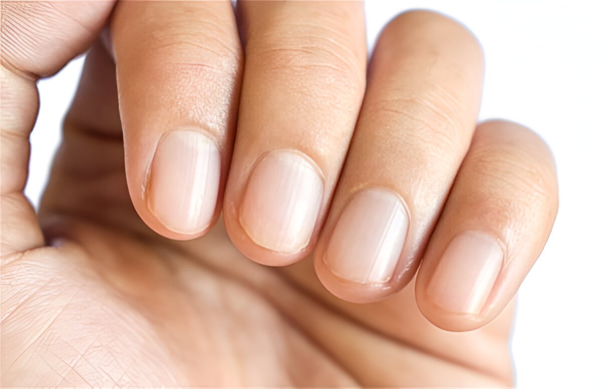 Nail Pitting: Causes, Symptoms, and Treatment Options