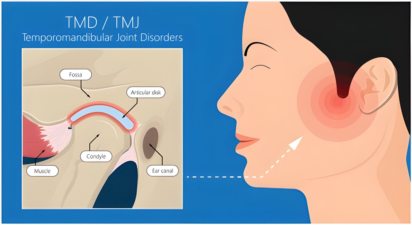 Effective Ways to Treat Jaw Popping and Clicking