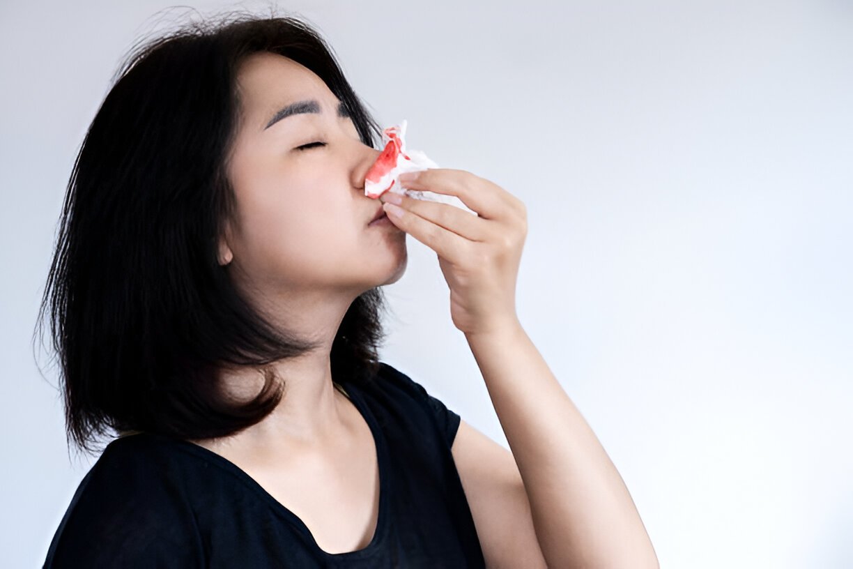 when to worry about a nosebleed