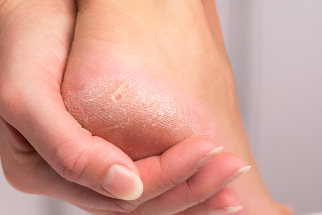 Understanding Hyperkeratosis: Symptoms, Causes, and Treatments