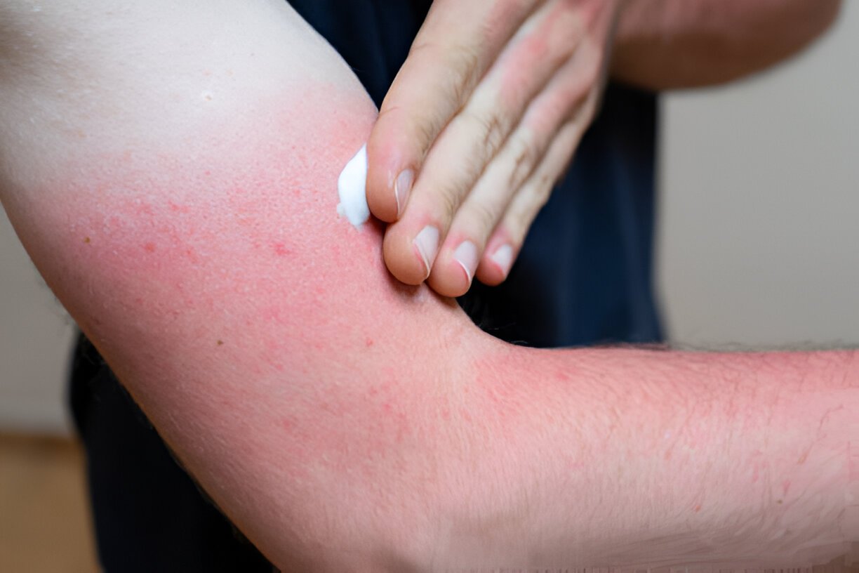 A Guide to Mild Shingles Rash Pictures and Symptoms