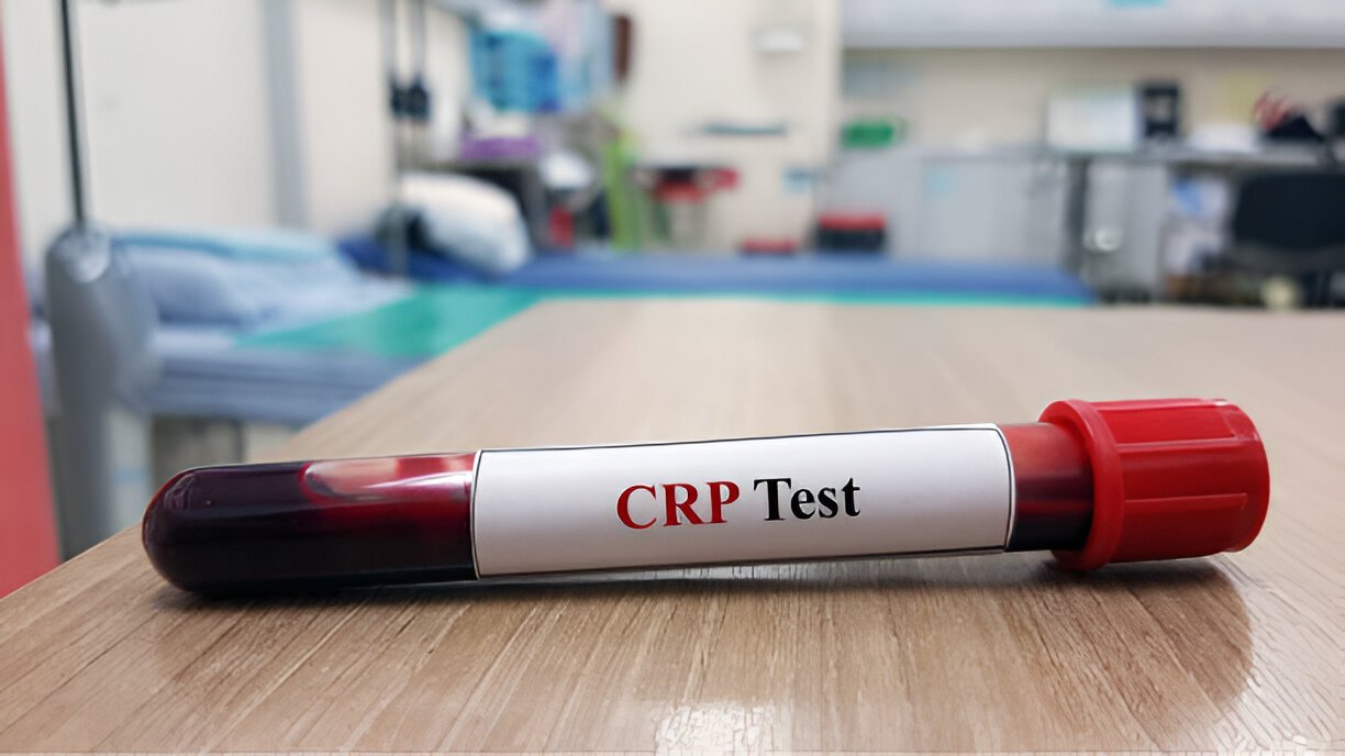 How Much CRP Level is Dangerous: What You Should Be Aware Of