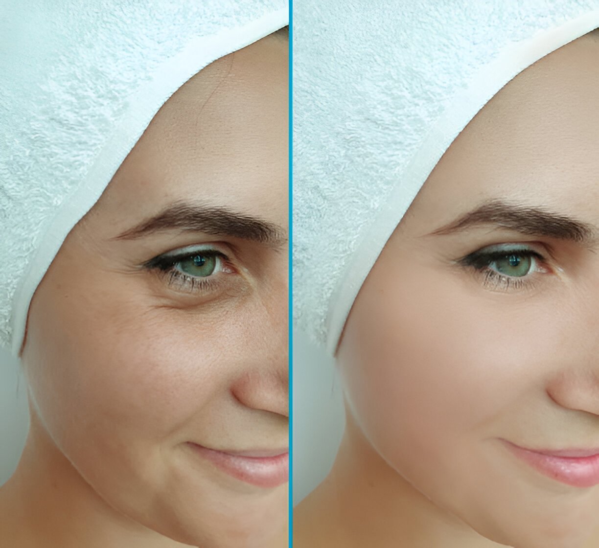 Chemical Peel Before and After: Stunning Results and Expert Tips