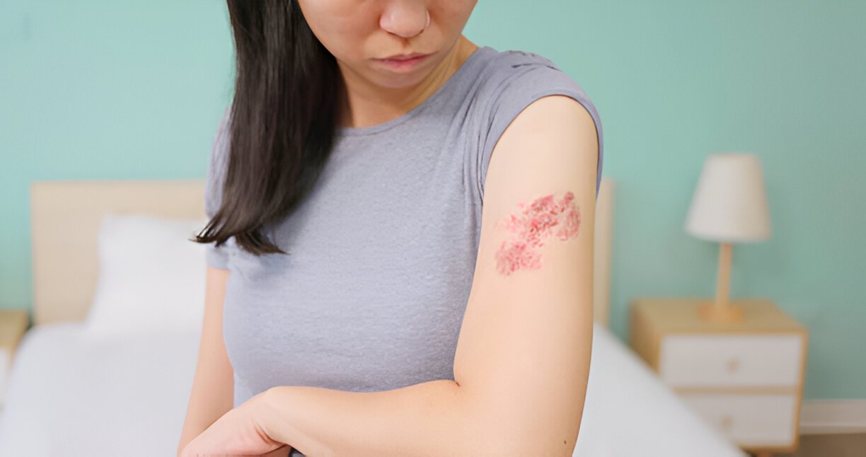 Shingles Images: Identifying the Rash and Its Stages